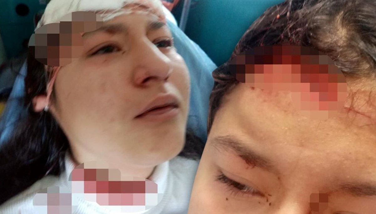 14 yaşındaki çocuğa selfie çekerken 5 köpek saldırdı